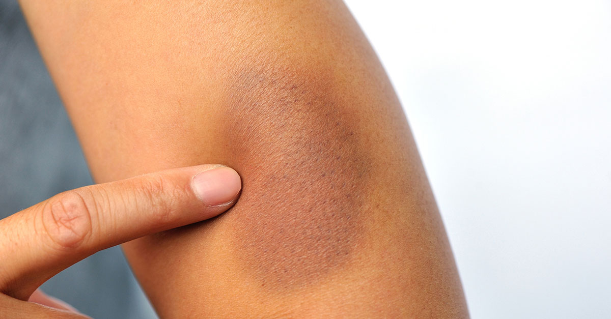 BruiseDisappear_1200