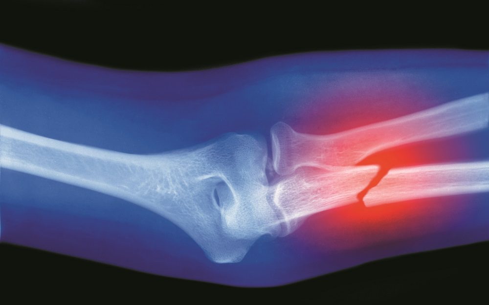 xray of broken arm