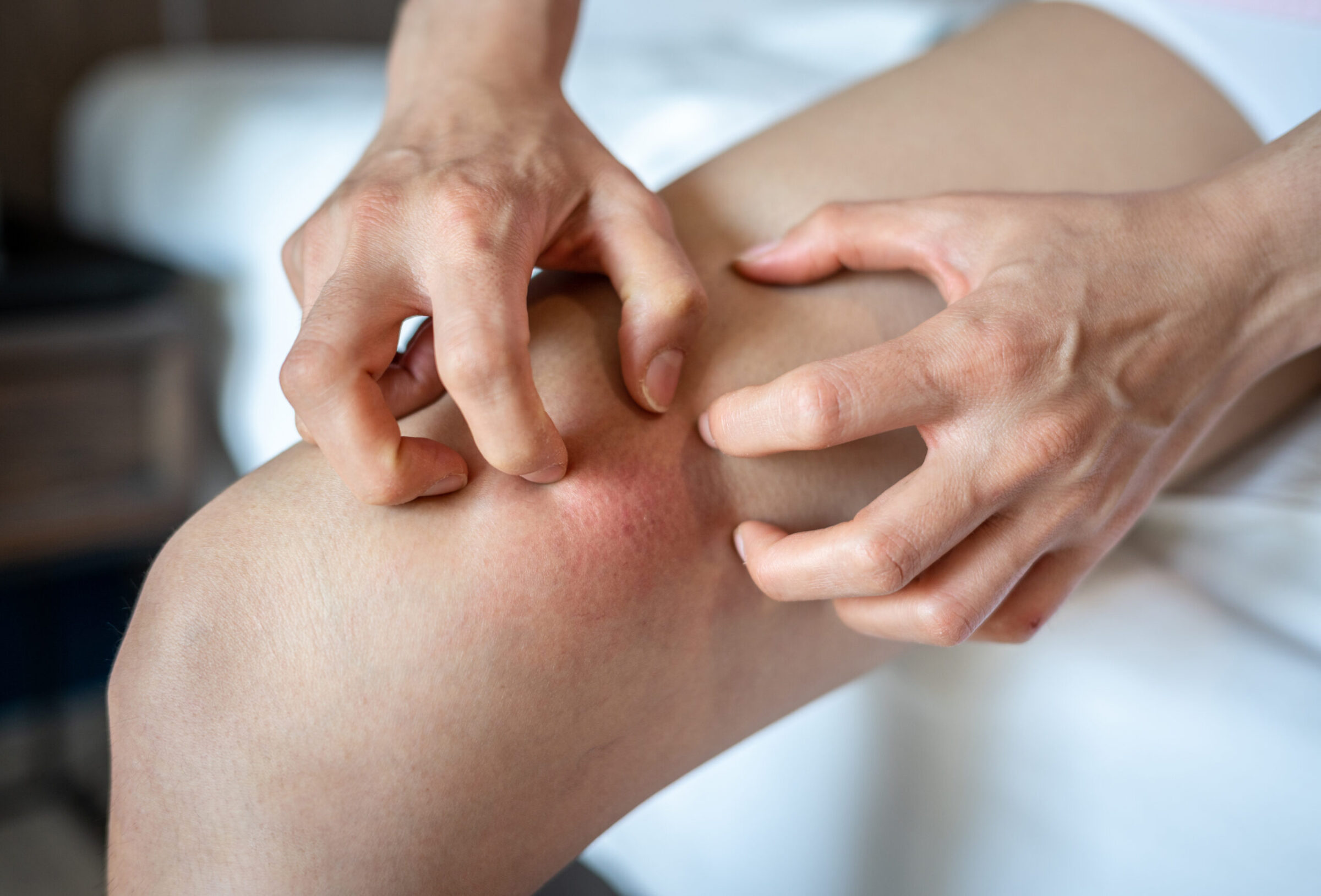 Close up of woman having itch caused of a red rash on her thigh.