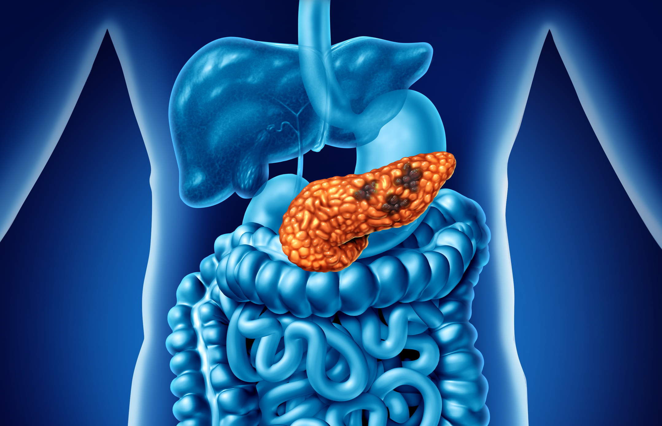 pancreatic cancer